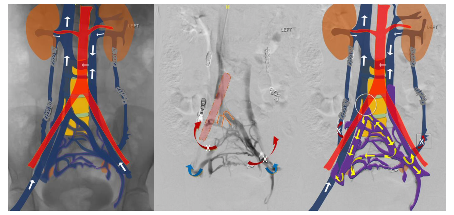 An Unusual Cause of Pelvic Congestion Syndrome VDM